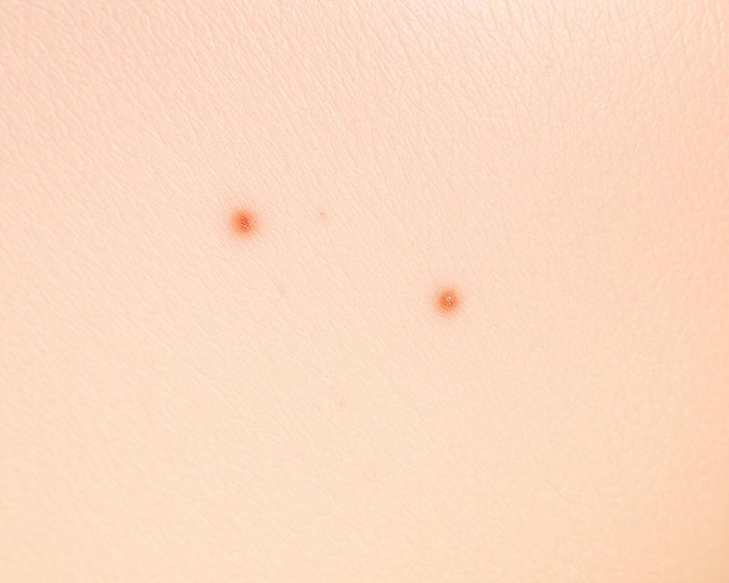 Zaskórniki: przyczyny, objawy i skuteczne metody walki z nimi